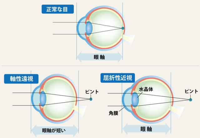 遠視とは？ – 視力回復ビジョンサロントレーニングメガネ