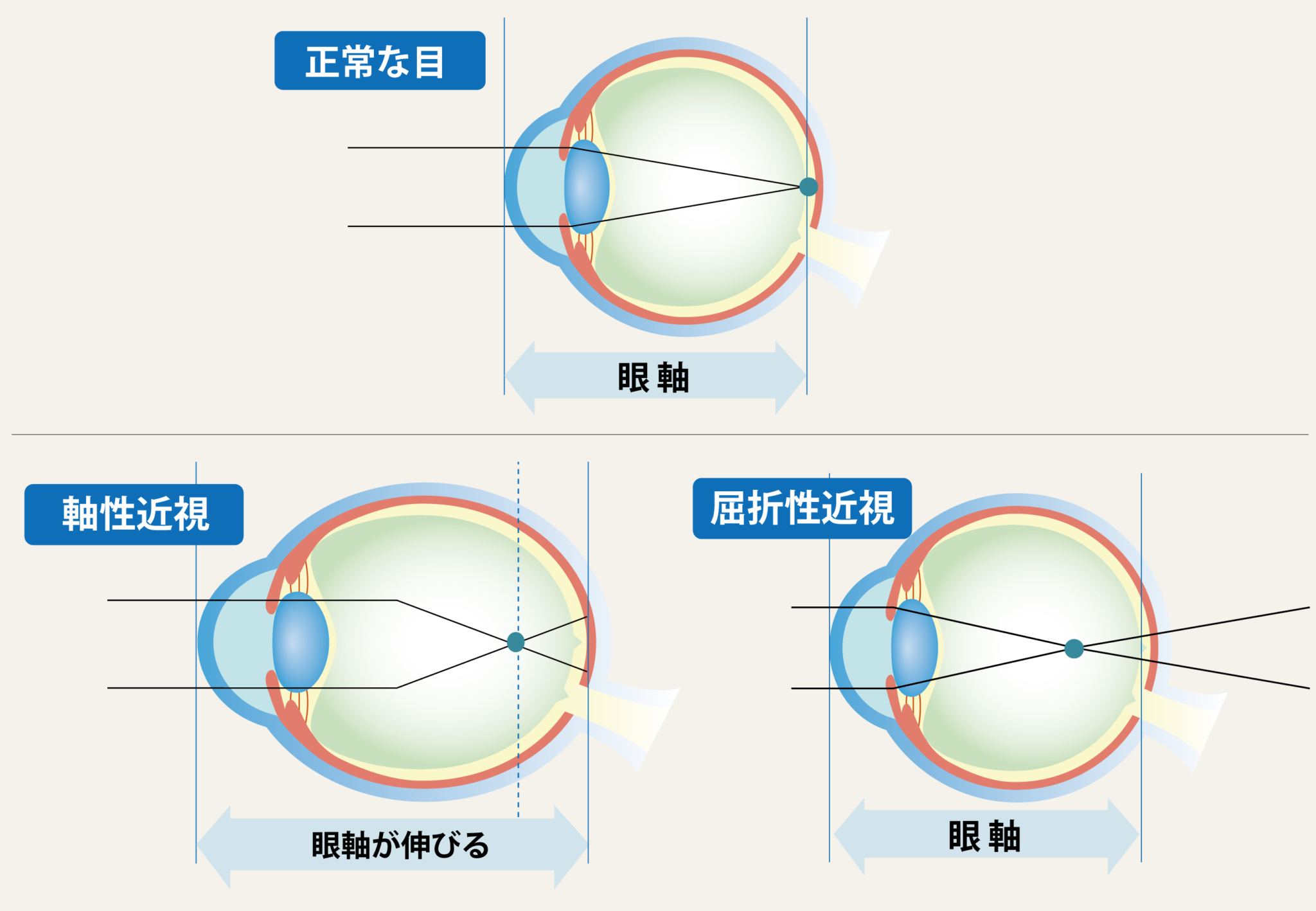 近視とは? – 視力回復ビジョンサロントレーニングメガネ